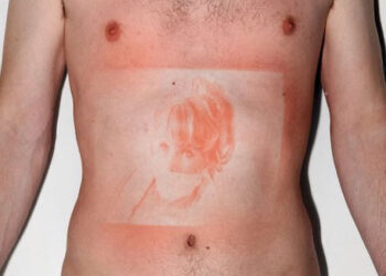UV lamp Sunburn Photos By Thomas Mailaender (2015)