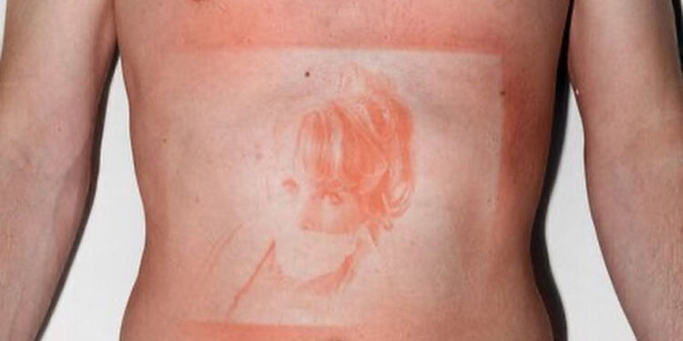 UV lamp Sunburn Photos By Thomas Mailaender (2015)